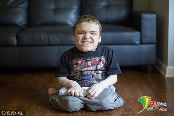 美国18岁少年患罕见侏儒症 体型如幼儿